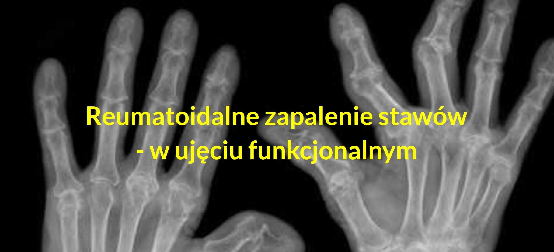 Reumatoidalne zapalenie stawów - w ujęciu funkcjonalnym